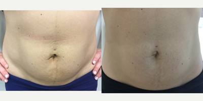 CoolSculpting before and after photo