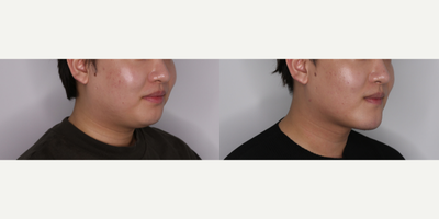 Chin Liposuction before and after photo