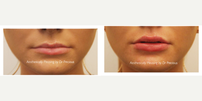 Lip Fillers before and after photo