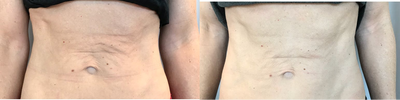Skin Tightening before and after photo