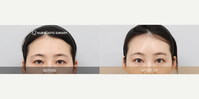 Brow Lift before and after photo