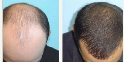 Hair Transplant before and after photo