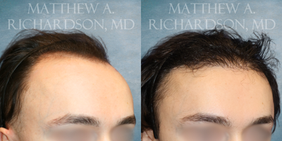 Hair Transplant before and after photo