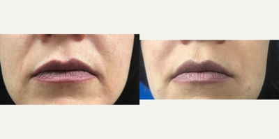 Restylane Defyne before and after photo