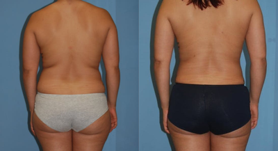 Breast Fat Transfer before and after photo