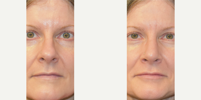 Dermal Fillers before and after photo