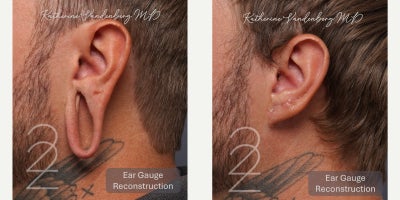 Earlobe Repair before and after photo