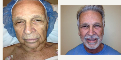 Facelift before and after photo