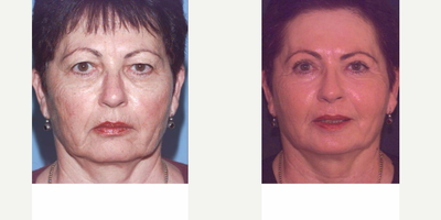 Laser Resurfacing before and after photo