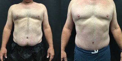 Male Tummy Tuck before and after photo