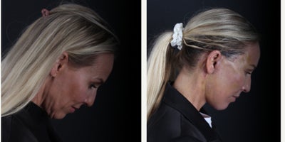 Neck Lift before and after photo