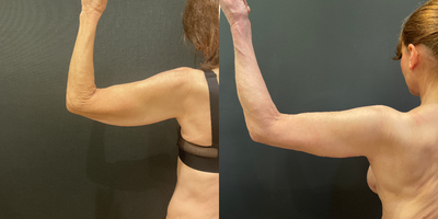 Arm Lift before and after photo