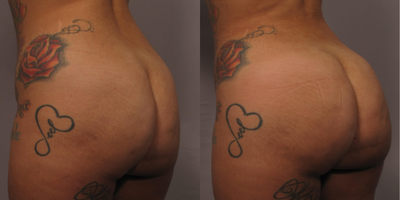Brazilian Butt Lift before and after photo