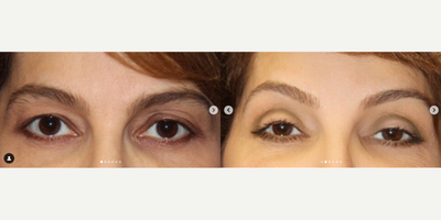Eyelid Surgery before and after photo
