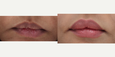 Lip Fillers before and after photo
