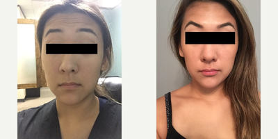 Botox before and after photo