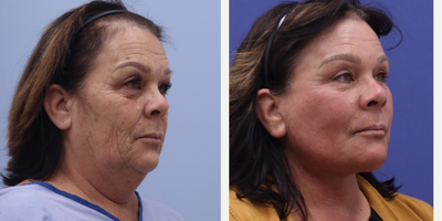 CO2 Laser before and after photo