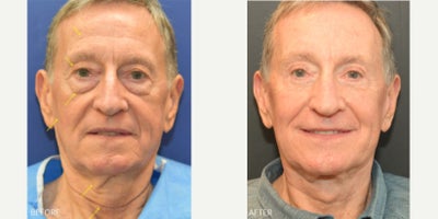 Eyelid Surgery before and after photo