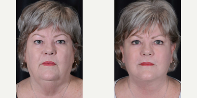 Facelift before and after photo