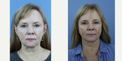 Facelift before and after photo