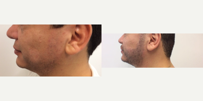 Hair Transplant before and after photo