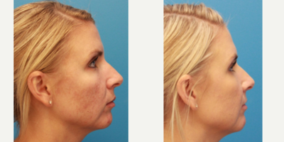 Halo Laser before and after photo