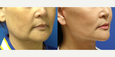 before and after image