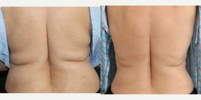 CoolSculpting before and after photo