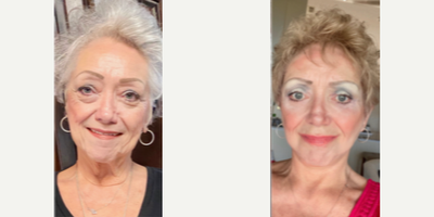Facelift before and after photo