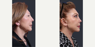 Neck Lift before and after photo