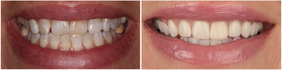 Porcelain Veneers before and after photo