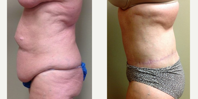 Body Lift before and after photo