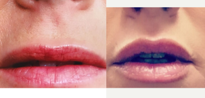 Lip Lift before and after photo