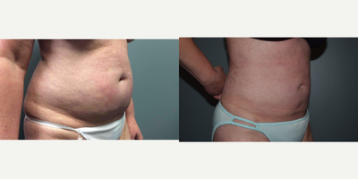 Liposuction before and after photo