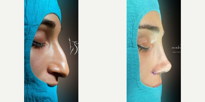 Rhinoplasty before and after photo