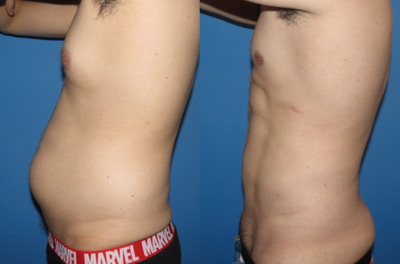Vaser Liposuction before and after photo