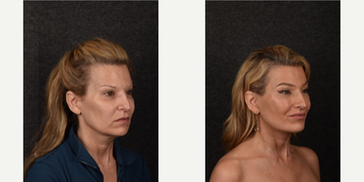 Facial Fat Transfer before and after photo