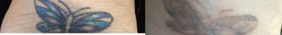 Tattoo Removal before and after photo
