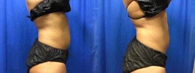 truSculpt before and after photo
