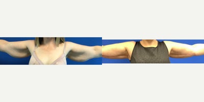 Arm Lift before and after photo