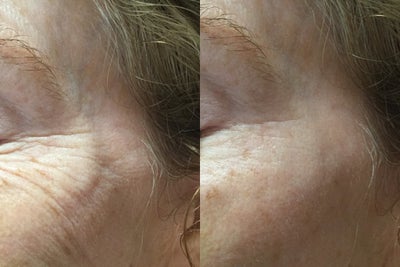 Dermal Fillers before and after photo