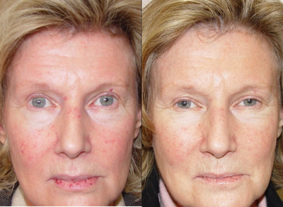 IPL before and after photo