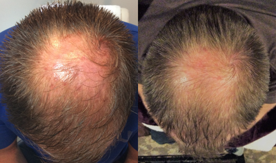 PRP for Hair Loss before and after photo