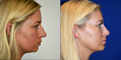 Rhinoplasty before and after photo