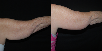 Arm Lift before and after photo