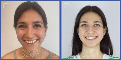 Braces before and after photo