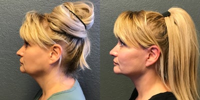 Facelift before and after photo