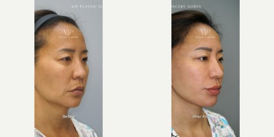 Facelift before and after photo