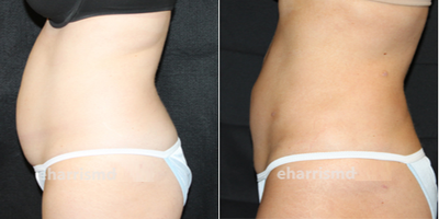 Liposuction before and after photo