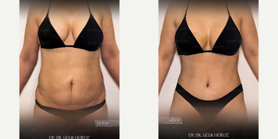Liposuction before and after photo